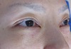 DR.近藤オリジナル　切らない　目の下のくま・たるみとり　 自己再生TCB  術直後写真