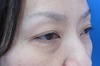 DR.近藤オリジナル　切らない　目の下のくま・たるみとり　 自己再生TCB  術直後写真