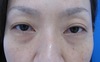 DR.近藤オリジナル　切らない　目の下のくま・たるみとり　 自己再生TCB  術直後写真