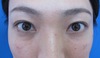目の下のクマ・たるみでお悩みの方へ（膨らみと凹みの混在した方）：DR近藤オリジナル　TCB-R
