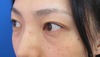 目の下のクマ・たるみでお悩みの方へ（膨らみと凹みの混在した方）：DR近藤オリジナル　TCB-R