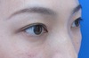 目の下のクマ・たるみでお悩みの方へ（膨らみと凹みの混在した方）：DR近藤オリジナル　TCB-R