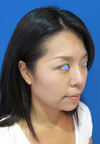 手術でなくても、こんなに綺麗になれます。DR近藤　こだわりのラディエッセ注入・PPP-GEL注入（アゴ、鼻、ゴルゴライン、口角）