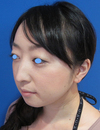 微妙な変化が　自然な美人創りを　実現します。　DR近藤　こだわりのラディエッセ注入・PPP-GEL注入（アゴ、鼻）注入3週後