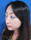 微妙な変化が　自然な美人創りを　実現します。　DR近藤　こだわりのラディエッセ注入・PPP-GEL注入（アゴ、鼻）注入3週後