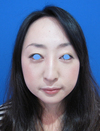 微妙な変化が　自然な美人創りを　実現します。　DR近藤　こだわりのラディエッセ注入・PPP-GEL注入（アゴ、鼻）注入3週後