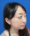 微妙な変化が　自然な美人創りを　実現します。　DR近藤　こだわりのラディエッセ注入・PPP-GEL注入（アゴ、鼻）注入3週後