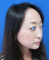 微妙な変化が　自然な美人創りを　実現します。　DR近藤　こだわりのラディエッセ注入・PPP-GEL注入（アゴ、鼻）注入3週後