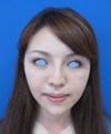 綺麗な人がより美しく！　DR近藤　こだわりのラディエッセ注入・PPP-GEL注入（アゴ、鼻、ゴルゴライン、目の下）