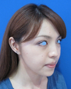 綺麗な人がより美しく！　DR近藤　こだわりのラディエッセ注入・PPP-GEL注入（アゴ、鼻、ゴルゴライン、目の下）