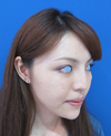 綺麗な人がより美しく！　DR近藤　こだわりのラディエッセ注入・PPP-GEL注入（アゴ、鼻、ゴルゴライン、目の下）