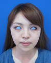 綺麗な人がより美しく！　DR近藤　こだわりのラディエッセ注入・PPP-GEL注入（アゴ、鼻、ゴルゴライン、目の下）