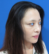 DR.近藤オリジナル 切らないお顔の引き上げ術　チタンペックリフト（術後3週）