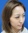 その方本来の美しさを引き出すプチ整形・　二重術＆アゴ・鼻