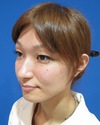 美創り：持続性をUP!　ワンランク上のPPP-GEL（ジェル）  SOグレイスオリジナル　コラーゲン新生PPP-GEL注入療法　チーク注入