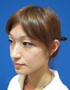 美創り：持続性をUP!　ワンランク上のPPP-GEL（ジェル）  SOグレイスオリジナル　コラーゲン新生PPP-GEL注入療法　チーク注入