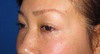 DR.近藤オリジナル　切らない　目の下のくま・たるみとり　 自己再生TCB  術直後写真