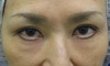 DR.近藤オリジナル　切らない　目の下のくま・たるみとり　 自己再生TCB  術直後写真