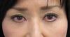 DR.近藤オリジナル　切らない　目の下のくま・たるみとり　 自己再生TCB  術２ヶ月後写真