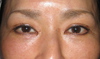 DR.近藤オリジナル　切らない　目の下のくま・たるみとり　 自己再生TCB  術直後写真
