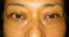 目の下のクマ・たるみでお悩みの方へ（膨らみと凹みの混在した方）：DR近藤オリジナル　TCB-R　術直後写真