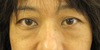 目の下のクマ・たるみでお悩みの方へ（膨らみと凹みの混在した方）：DR近藤オリジナル　TCB-R　術直後写真