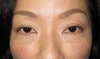 目の下のクマ・たるみでお悩みの方へ（膨らみと凹みの混在した方）：DR近藤オリジナル　切らない目の下のたるみとり　自己再生・TCB-R　術3週後写真