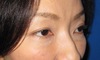 目の下のクマ・たるみでお悩みの方へ（膨らみと凹みの混在した方）：DR近藤オリジナル　切らない目の下のたるみとり　自己再生・TCB-R　術3週後写真