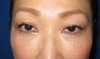 目の下のクマ・たるみでお悩みの方へ（膨らみと凹みの混在した方）：DR近藤オリジナル　切らない目の下のたるみとり　自己再生・TCB-R　術６週後写真