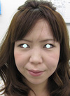 手術でなくても、こんなに綺麗になれます。DR近藤　こだわりのラディエッセ注入・PPP-GEL注入（鼻、ゴルゴライン、チーク）注入直後写真