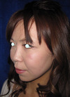手術でなくても、こんなに綺麗になれます。DR近藤　こだわりのラディエッセ注入・PPP-GEL注入（鼻、ゴルゴライン、チーク） 注入直後写真