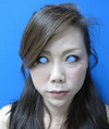 手術でなくても、プチ整形でこんなに綺麗になれます。DR近藤こだわりのラディエッセ注入（アゴ、ゴルゴライン・チーク、口角）注入直後写真