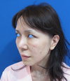 DR.近藤オリジナル 切らないお顔の引き上げ術　チタンペックリフト +　グレイスオリジナル・コラーゲン新生PPP-GEL注入療法