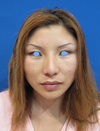 DR.近藤オリジナル 切らないお顔の引き上げ術　チタンペックリフト（術直後写真）