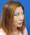 DR.近藤オリジナル 切らないお顔の引き上げ術　チタンペックリフト（術直後写真）