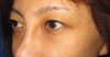 当院独自の極細専用糸・手術顕微鏡にて行う 「切らない二重術（切らない上まぶたのたるみとり）・Grace　埋没　二重術」術後一ヶ月