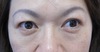 DR.近藤オリジナル　切らない　目の下のくま・たるみとり　 術直後写真