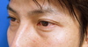 美容外科は女性のためだけのものではありません：Dr.近藤オリジナル　切らない目の下のたるみとり　自己再生TCB　術直後写真
