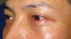 美容外科は女性のためだけのものではありません：Dr.近藤オリジナル　切らない目の下のたるみとり　自己再生TCB　術直後写真