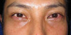 美容外科は女性のためだけのものではありません：Dr.近藤オリジナル　切らない目の下のたるみとり　自己再生TCB　術直後写真