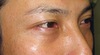 美容外科は女性のためだけのものではありません：Dr.近藤オリジナル　切らない目の下のたるみとり　自己再生TCB　術直後写真