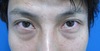 目の下のクマ・たるみでお悩みの方へ　ダウンタイムは最小限！！：DR近藤オリジナル　TCB-R　男性症例