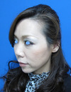 手術でなくても、こんなに綺麗になれます。DR近藤　こだわりのラディエッセ注入・PPP-GEL注入（アゴ、鼻、ゴルゴライン、口角）