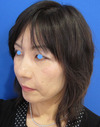 手術でなくても、プチ整形でこんなに綺麗になれます。DR近藤こだわりのラディエッセ・PPP-GEL注入療法（法令線）注入直後写真