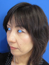 手術でなくても、プチ整形でこんなに綺麗になれます。DR近藤こだわりのラディエッセ・PPP-GEL注入療法（法令線）注入直後写真