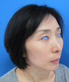手術でなくても、こんなに綺麗になれます。DR近藤　こだわりのラディエッセ注入・PPP-GEL注入（目の上の凹み、チーク、アゴ）注入直後写真