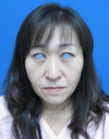 年末年始のお休み　チタンペックリフトで若返って素敵になりませんか：「DR近藤オリジナル　切らないお顔のたるみとり：チタンペックリフト」　　