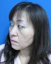 年末年始のお休み　チタンペックリフトで若返って素敵になりませんか：「DR近藤オリジナル　切らないお顔のたるみとり：チタンペックリフト」　　