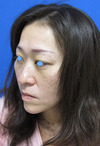 年末年始のお休み　チタンペックリフトで若返って素敵になりませんか：「DR近藤オリジナル　切らないお顔のたるみとり：チタンペックリフト」　　