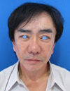 美容外科は女性のためだけのものではありません：Dr.近藤オリジナル　切らないお顔のたるみとり　チタンペックリフト　＆　ラディエッセ注入